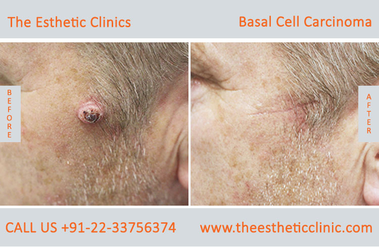 Basal Cell Carcinoma Treatment Surgery before after photos in mumbai india (6)